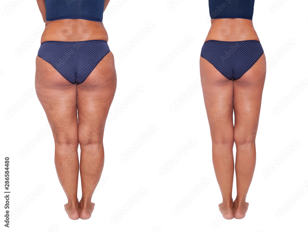Comparison before and after weight loss. Women's legs. The result of  liposuction. The fight against obesity and cellulite. Skin rejuvenation.  Fitness and nutrition. Stock Photo | Adobe Stock