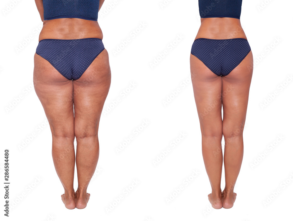 Comparison Before And After Weight Loss Women s Legs The Result Of 