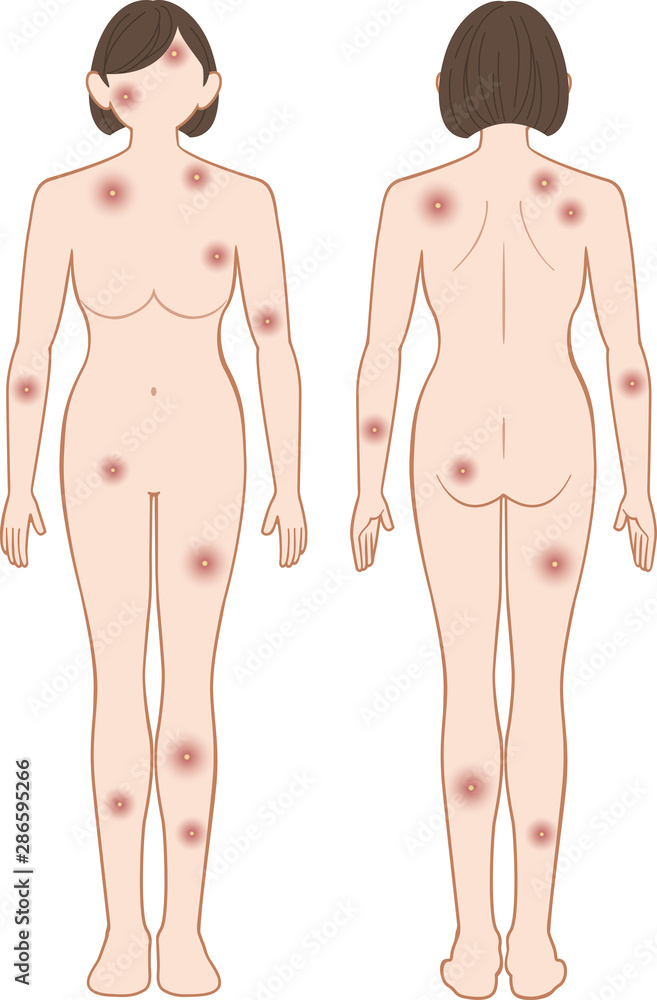 Fototapeta premium 化膿 全身 女性