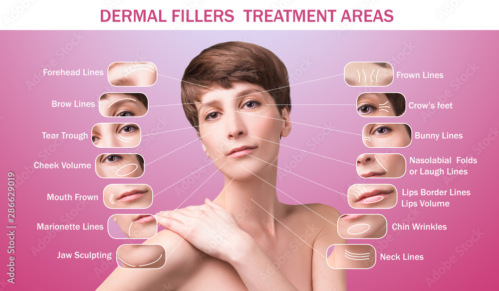 Treatment areas for anti-wrinkle injection.