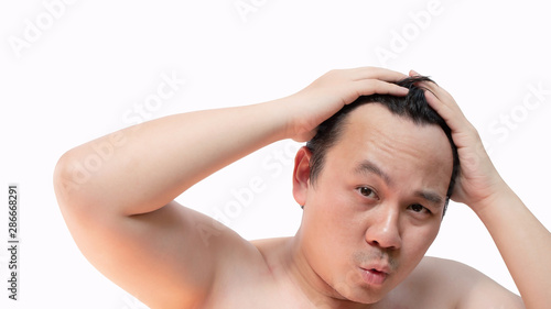 Asian bald man alopecia or hair loss isolated on white background with copy space.