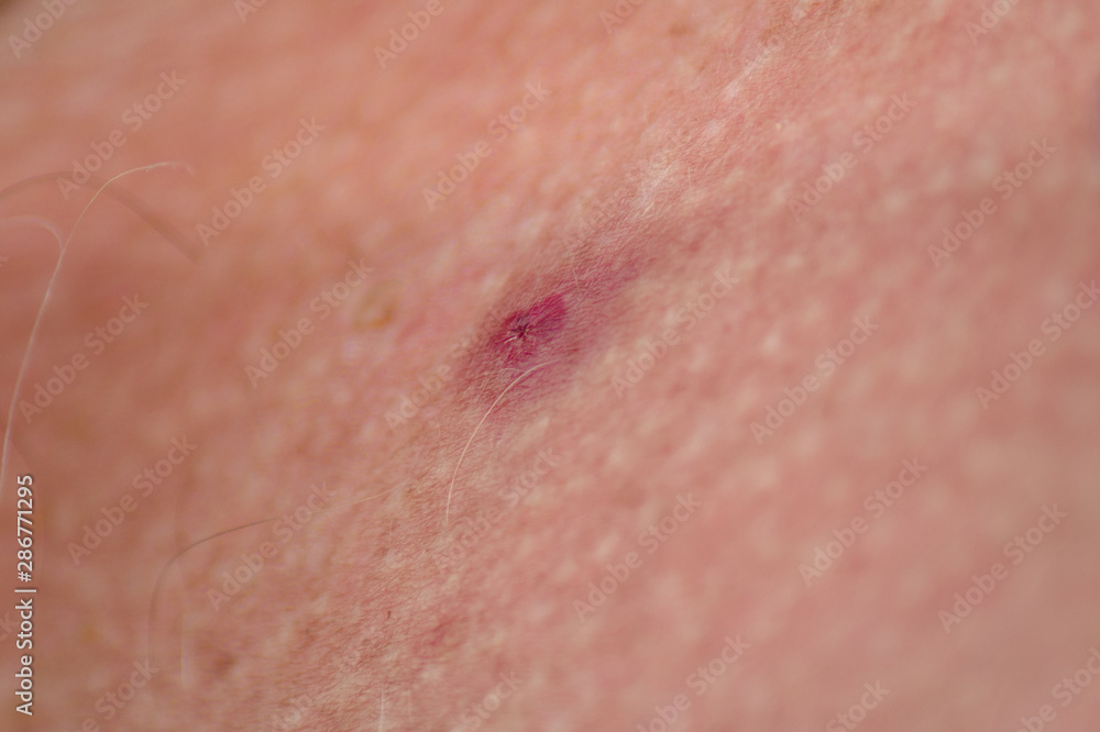 Leech bite mark.A wound on the human body from a leech sucker.Treatment  with leeches Photography, close-up. Stock Photo