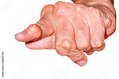Severe gout in men suffering from joint pain, bone pain, gout, rheumatoid symptoms, radioactive sickness, ill man concept of male osteoporosis, injured bone, injury, pain, arthritis,arm, foot, knee © Adul10