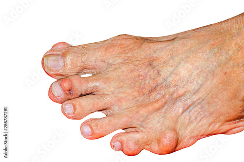 Severe gout in men suffering from joint pain, bone pain, gout, rheumatoid symptoms, radioactive sickness, ill man concept of male osteoporosis, injured bone, injury, pain, arthritis,arm, foot, knee photo