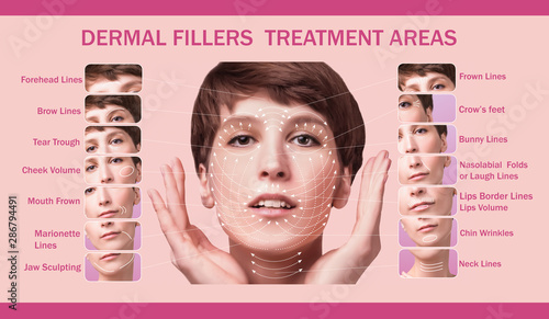 Treatment areas for anti-wrinkle injection. photo