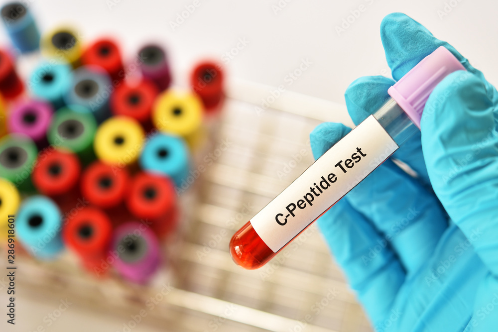 Fototapeta premium Blood sample tube for C-peptide test, diabetes diagnosis 