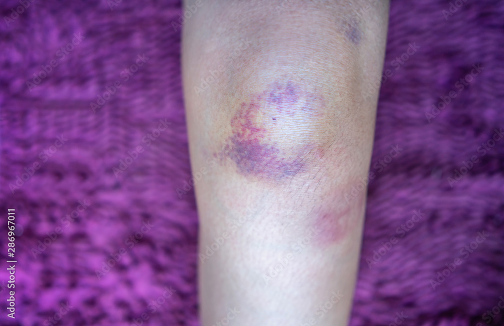 Fototapeta premium knee with a bruise.