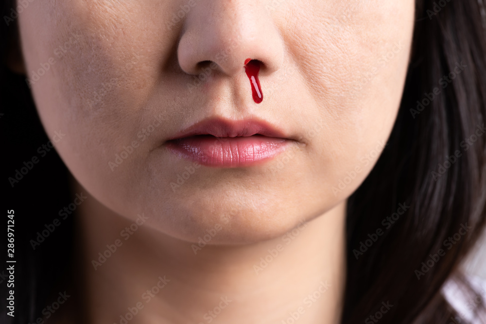 Obraz premium Nosebleed , a young woman with a bloody nose. Healthcare and medical concept.