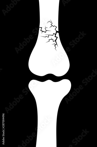 Bone fracture - cracks and deterioration of skeleton - injury and disease. Vector illustration. 