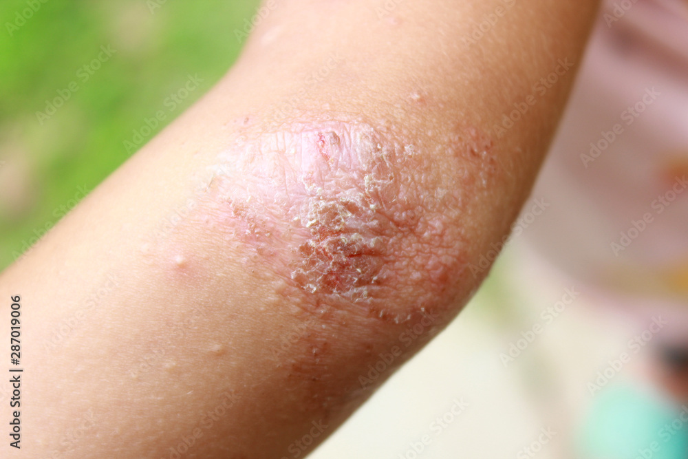 Children with eczama come from an itch that is allergic to air. Closeup eczama child skin. Children with eczama come from an itch that is allergic to air. Closeup eczama child skin.
