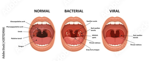 Tonsillitis bacterial and viral. Angina, pharyngitis and tonsillitis. Infection of tonsils. Open mouth