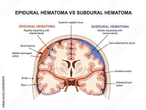 Epidural hematoma vs subdural hematoma photo