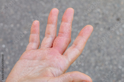 August 2019: a right hand with a bee bite, swelling hand, swollen finger