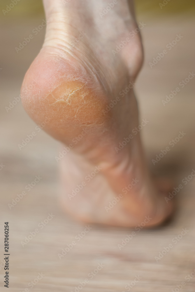 clavus and cracks on the heel of the foot clavus and cracks on the heel of the foot