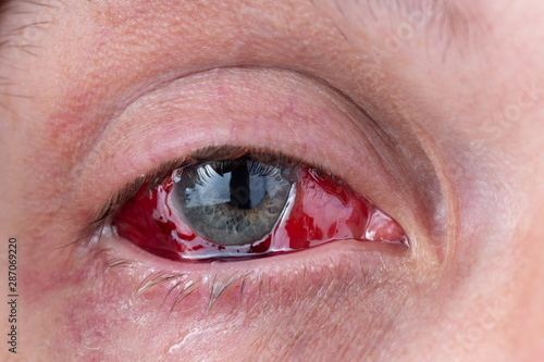 postoperative heavy inflamed eye closeup shot with selective focus photo