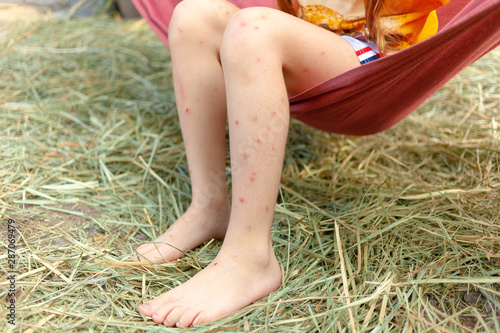 A shot of mosquitoes and bugs bite and scar spot on girl's legs sitting on the hammock