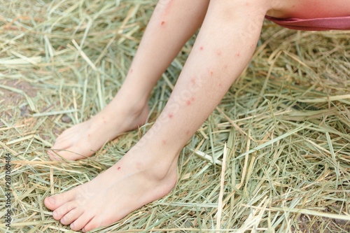 A shot of mosquitoes and bugs bite and scar spot on child legs