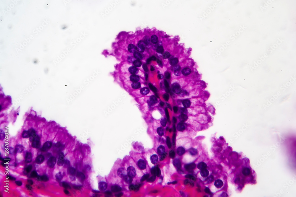 Benign prostatic hyperplasia, light micrograph, photo under microscope. High magnification showing papillary projections inside the lumen of the glands Benign prostatic hyperplasia, light micrograph, photo under microscope. High magnification showing papillary projections inside the lumen of the glands