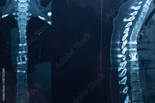 Quadro su tela spinal fracture