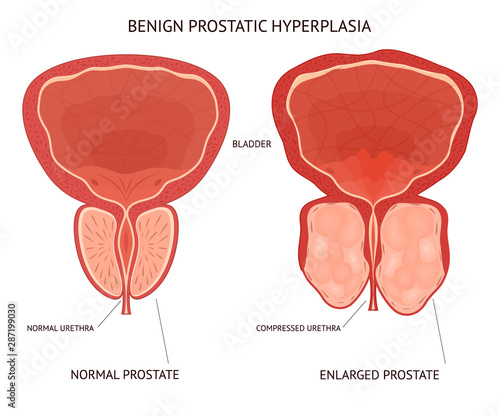Photos Cartoon Benign Prostatic Hyperplasia Infographics Concept Card Poster
