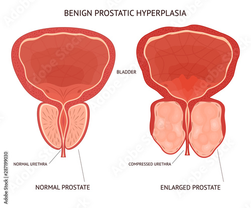 Cartoon Benign Prostatic Hyperplasia Infographics Concept Card Poster. Vector photo