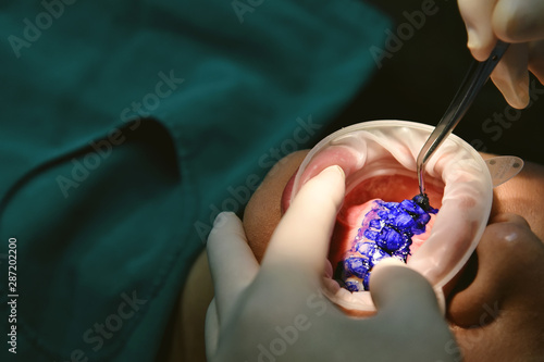 Dental care check up, Dentist examining and doing teeth treatment in dental clinic, Plaque disclosing, Color dye to spot the bacteria biofilm, Healthy oral hygienic. photo