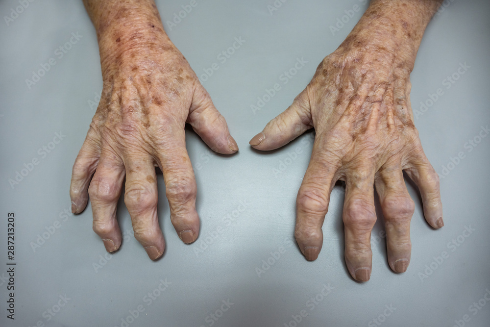 Mature patient with a osteoarthritis