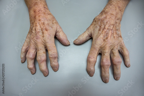 Mature patient with a osteoarthritis photo