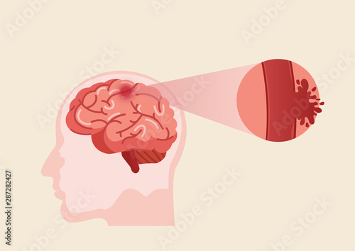 Human brain stroke illustration.