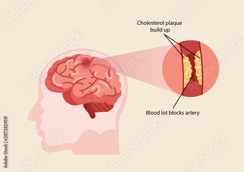 Human brain stroke illustration.