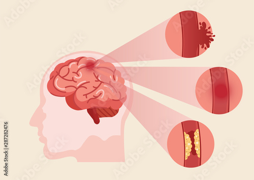 Human brain stroke illustration.