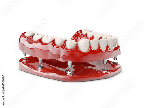 Human teeth and Dental implant. 3d illustration