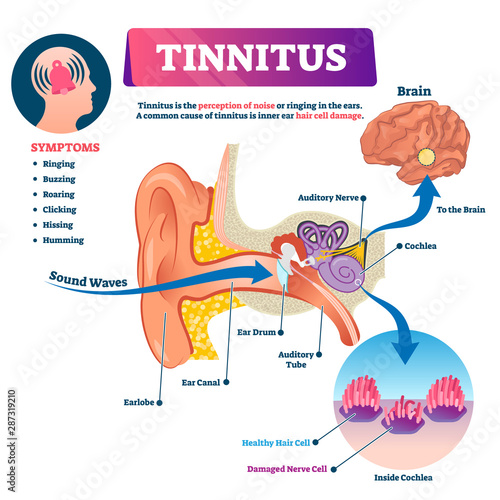 Tinnitus vector illustration. Labeled shingles noise perception ear problem photo
