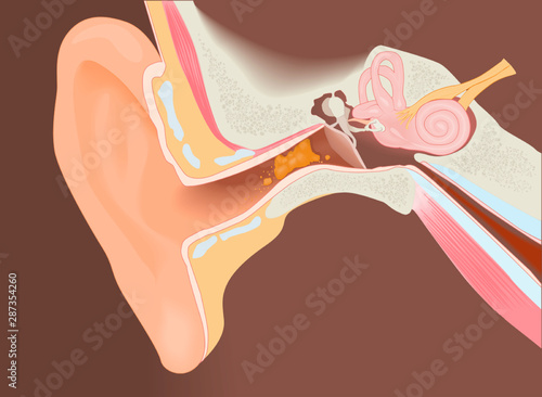 Section of the ear with the wax photo