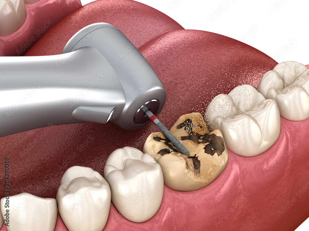 Caries removing process. Medically accurate tooth 3D illustration