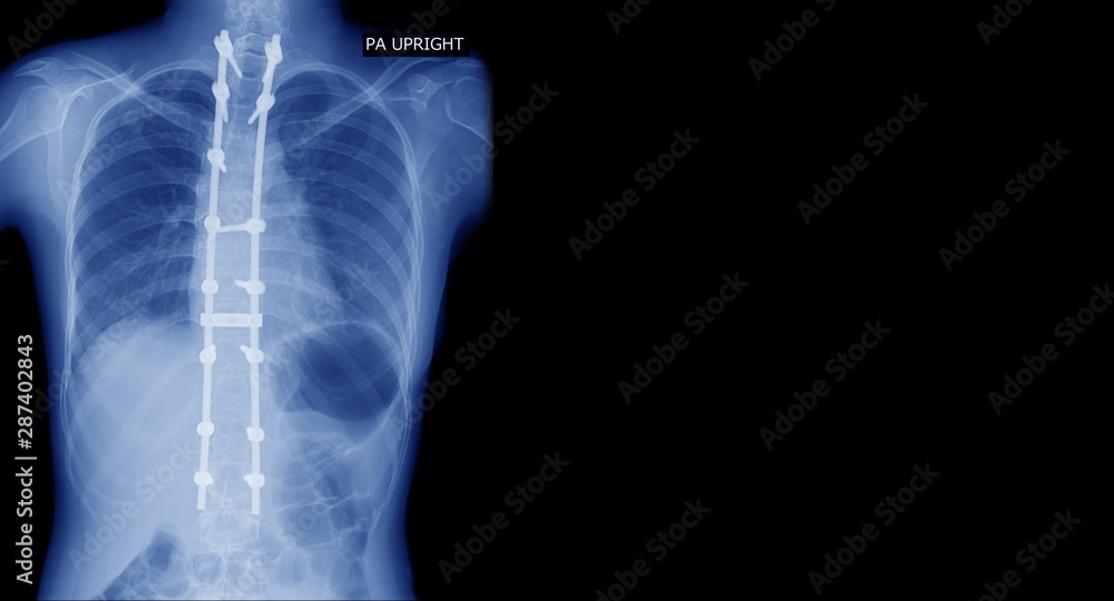 X-ray image of spine show Scoliosis deformity surgery fix by long metal rod and many screw for spinal bend in adult people. Adult scoliosis fix. Medical health care concepts. X-ray image of spine show Scoliosis deformity surgery fix by long metal rod and many screw for spinal bend in adult people. Adult scoliosis fix. Medical health care concepts.