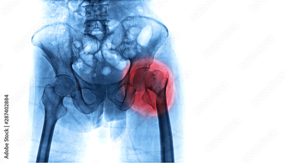 X-ray image of hip fracture in elderly people cause by falling process in blue tone with copy space. Medical and health care concepts. - obrazy, fototapety, plakaty 