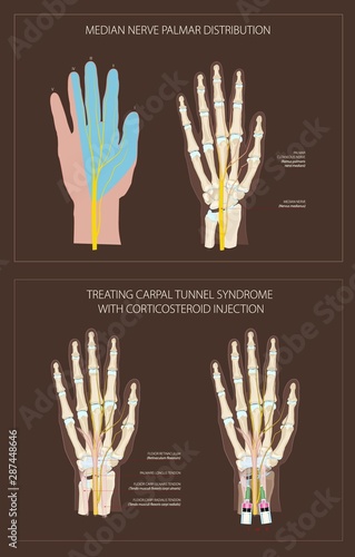 Carpal tunnel syndrome, treating with corticosteroid injection
