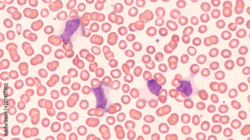Photomicrograph of peripheral blood smear showing atypical lymphocytes in patient with infectious mononucleosis.  This illness, caused by the Epstein Barr virus, is also know as the 