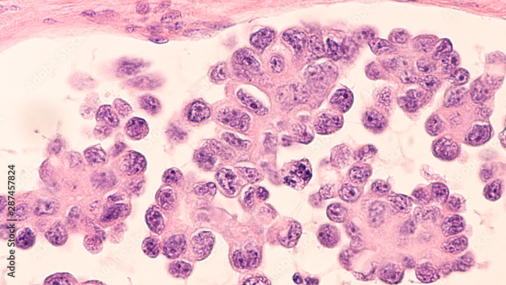 Foto Stock Ovarian Cancer Awareness Micrograph Of A Serous Papillary