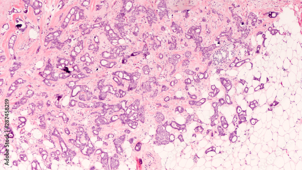 Breast Cancer Awareness: Microscopic image (photomicrograph) of an excision (lumpectomy) for infiltrating (invasive) cribriform  carcinoma, detected by screening mammogram. H & E stain.