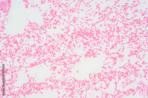 Bone marrow biopsy from myelodysplastic condition under the microscope view. photo