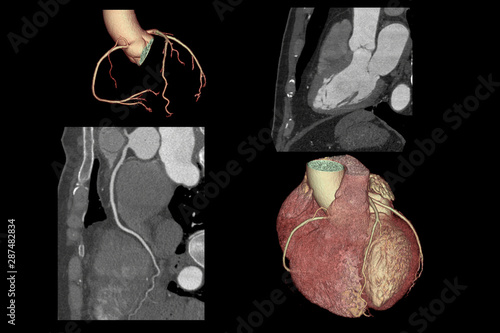 3D SCAN CTA Coronary artery, coronary tree with long axis view and vessel trace.