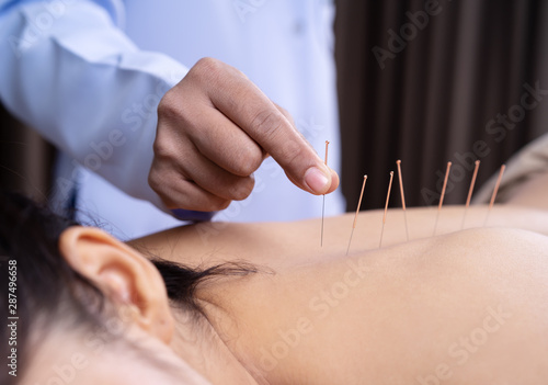 woman undergoing acupuncture treatment on back