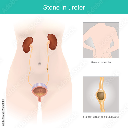 Stone in ureter.
