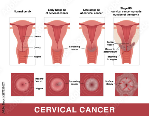 Cervical cancer. Three stages of cancer. Vector medical illustration with inscriptions. Female reproductive organs. Frontal view in a cut and top view.