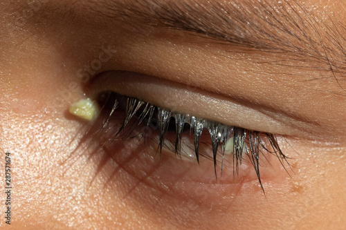 A macro view on the eye of a preschool boy, with red and puffy lower eyelid, yellow crusty discharge and watery lashes, symptomatic of viral conjunctivitis.