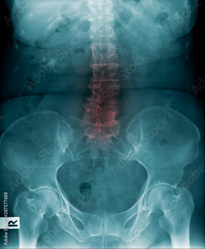 x-ray image lumbar spine and degenerative change of spine, l-spondylosis x-ray image in blue tone