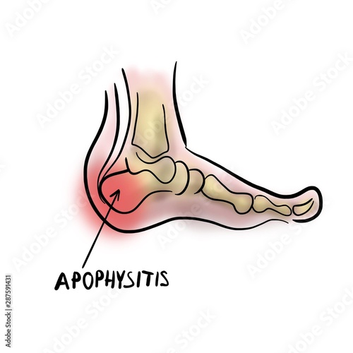 Inflammation of the apophysis of the calcaneus. photo