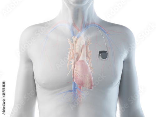 Canvas Print 3d rendered illustration of an old man with a pace maker